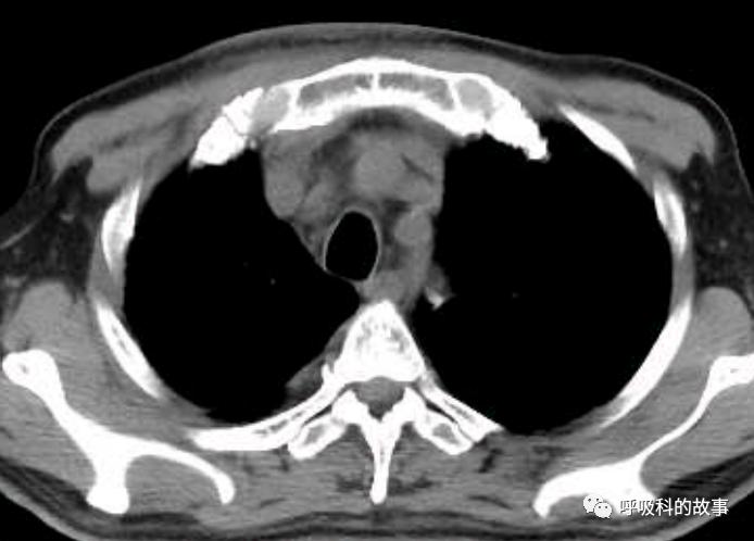 我是如何诊治肺炎的？（4）——如何理解抓住关键信息（2）