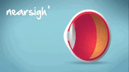 五岁半孩子眼睛散光需要干预吗,小孩眼睛散光跟家里灯光有关系吗