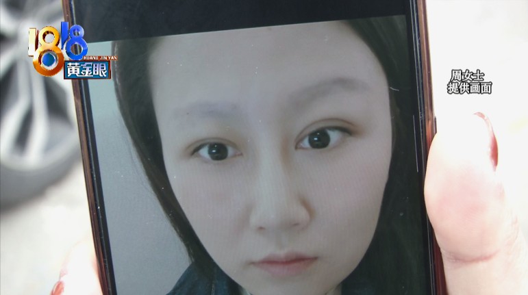 大饼脸变锥子脸,锥子脸长大后