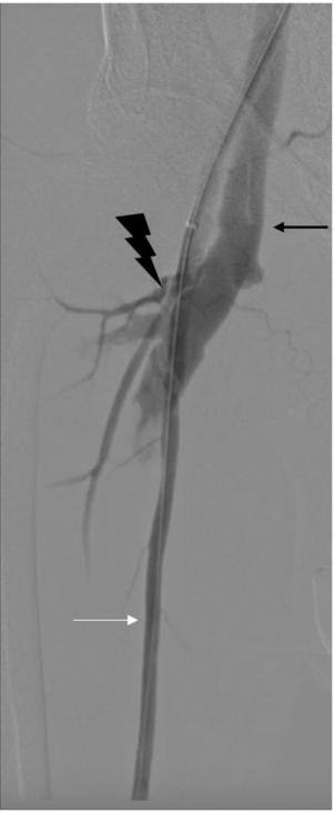 导管消融心衰病人做几次,心房颤动经导管射频消融并发症