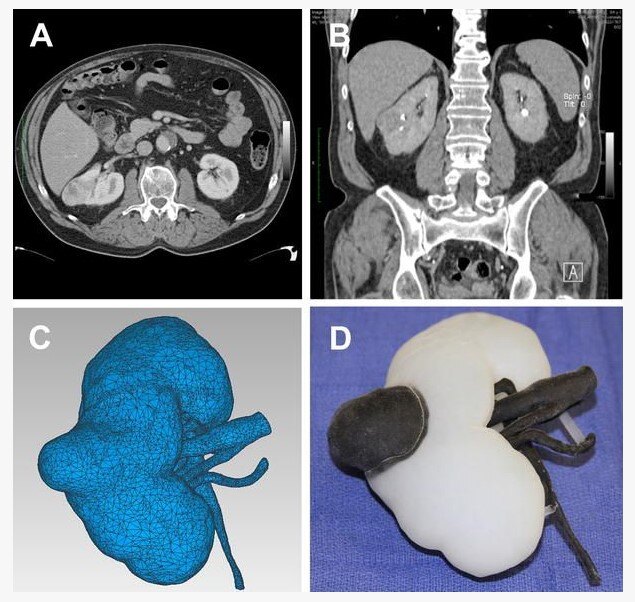 目前治愈肾癌的最好方法,早期肾癌的最新治疗方法