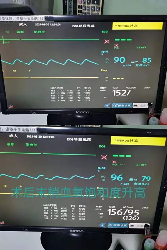 肺动静脉畸形介入手术成功率,肺动静脉畸形介入手术全过程