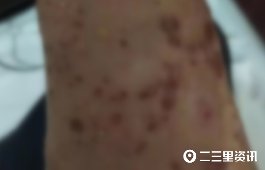 中医治疗水泡,治疗类大疱性天疱疮