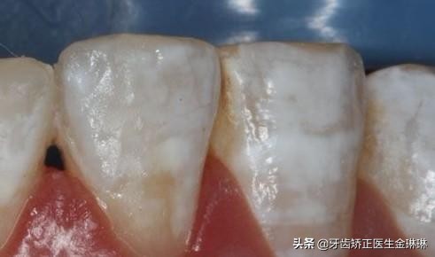 为什么河北人容易有氟斑牙,中国哪些地区会有氟斑牙