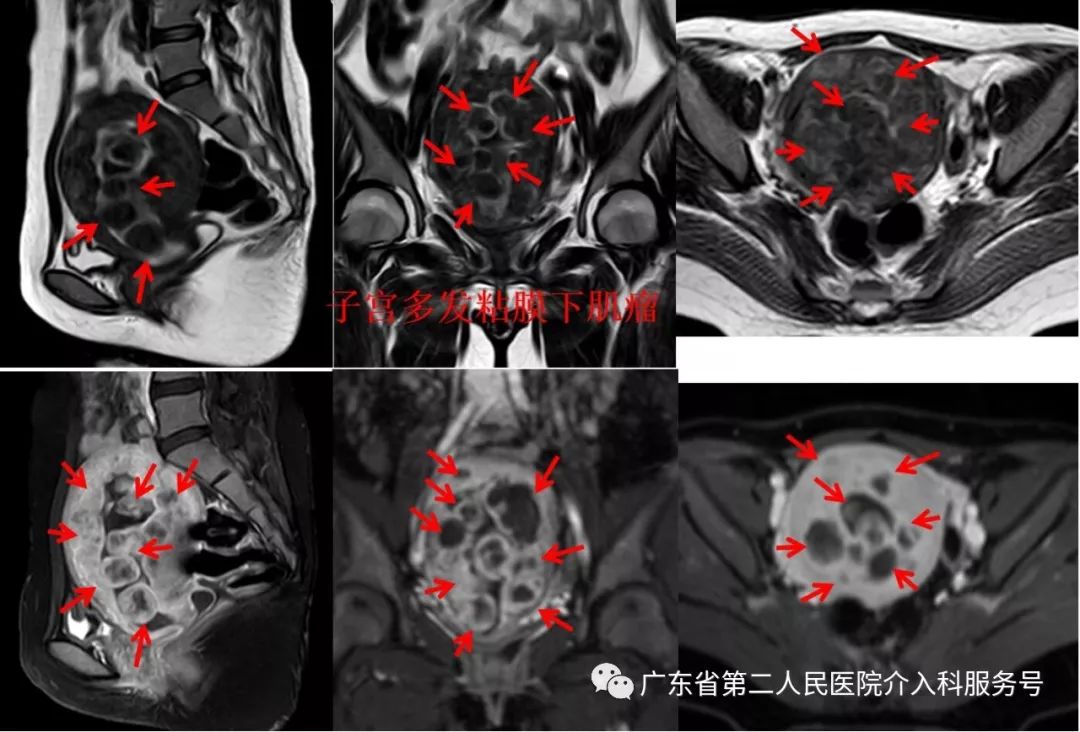 子宫多发肌瘤，月经量超多，重度贫血需输血，如何保宫治疗？