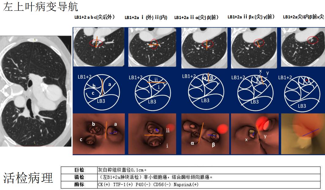 孙加源门诊,治疗肺癌的新技术新手段