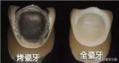 烤瓷牙和全瓷牙的区别哪种材料好,烤瓷牙和全瓷牙区别哪个更好