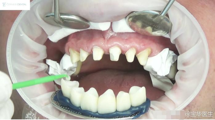 烤瓷牙贴片全口价格,贴片牙齿和烤瓷牙有哪些伤害