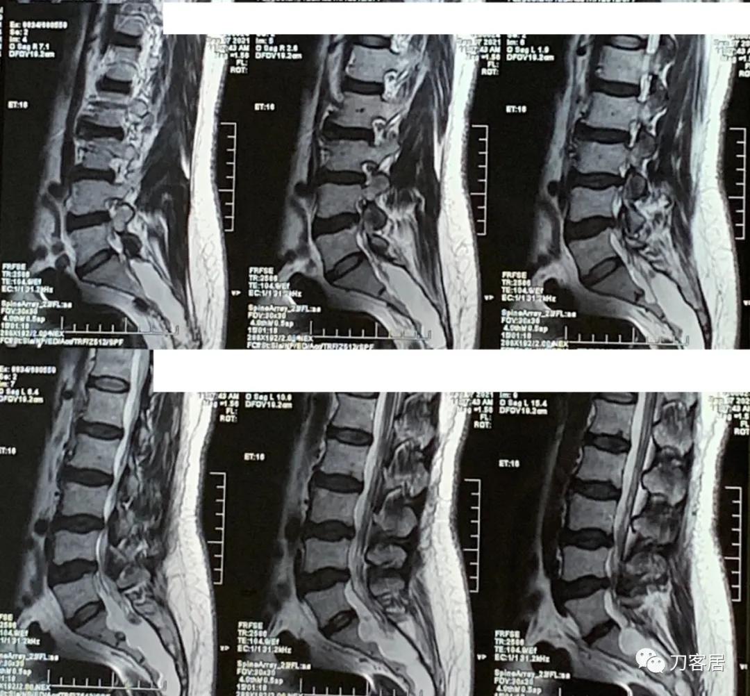 左下肢疼痛病历,门诊腹痛病历