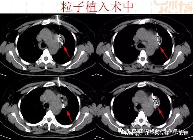 肺癌诊断与微创综合治疗,肺癌晚期的微创介入治疗