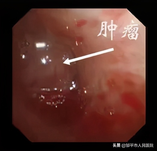 重症肺炎最佳治疗方法,满月宝宝重症肺炎如何治疗