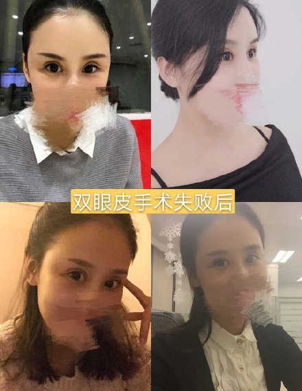 双眼皮手术后眼神凶狠是什么原因,双眼皮手术后显凶