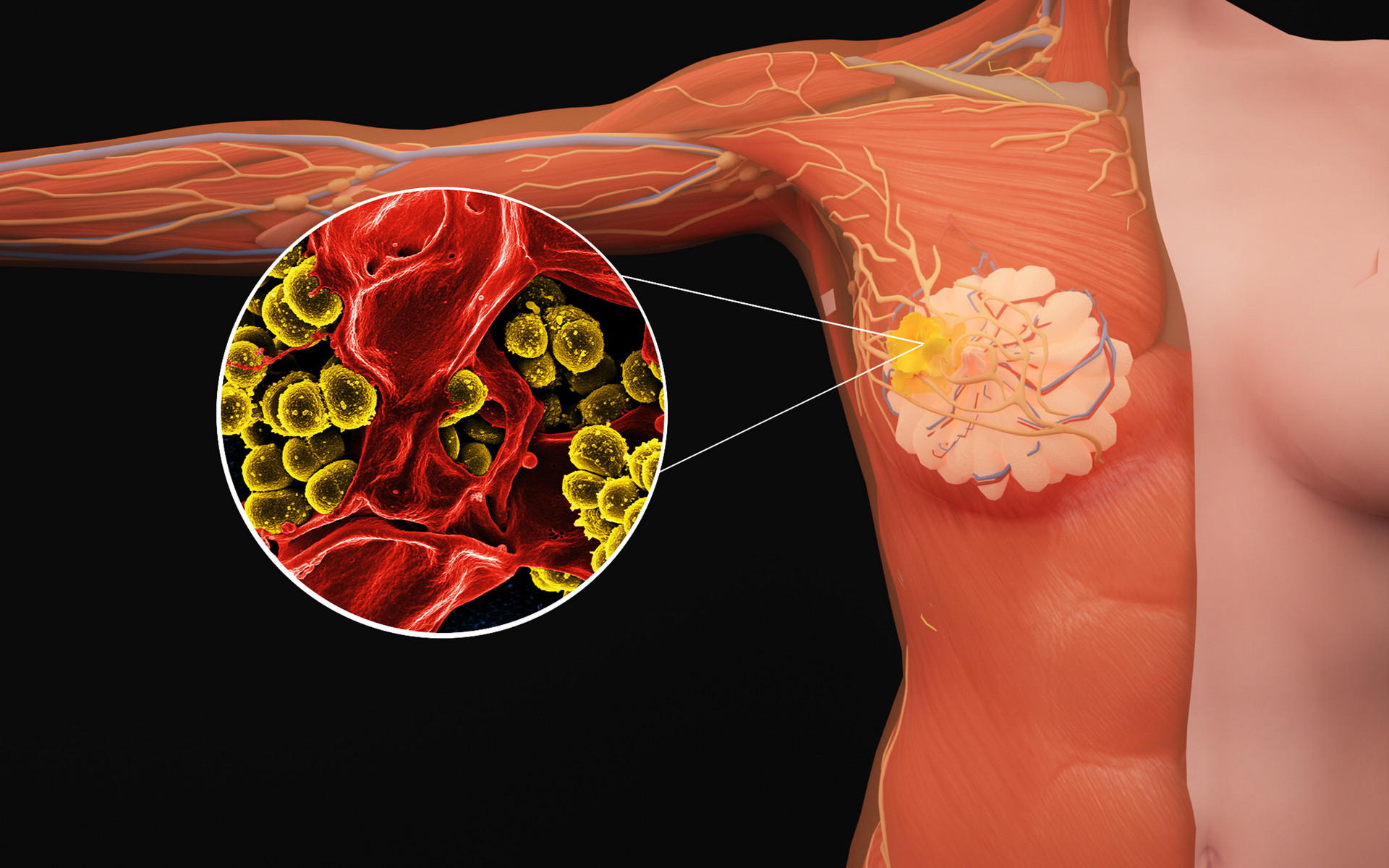 原位癌算不算重疾险,什么是原位癌有危险吗