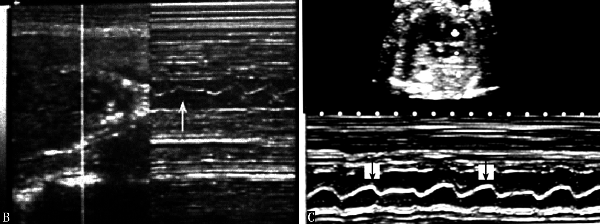 明明白白做超声（21）：胎儿发育生物物理学监测2-胎心活动及胎动