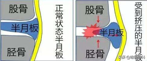 半月板科普小知识,半月板一二三度损伤报告