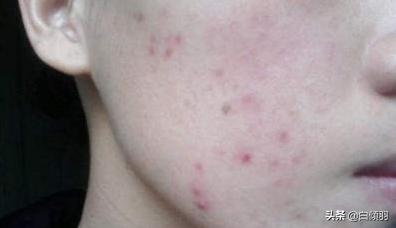 脸上痘印你们怎么消除的,脸上痘印运动可以清除吗