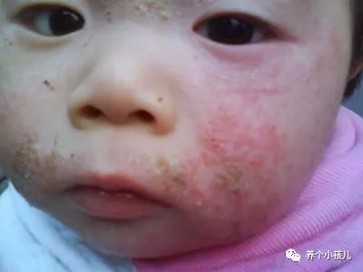 宝宝出现湿疹的原因和护理措施,高烧湿疹的症状及治疗方法