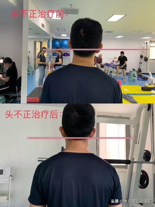 12岁孩子体态不正,体态不正导致大小脸