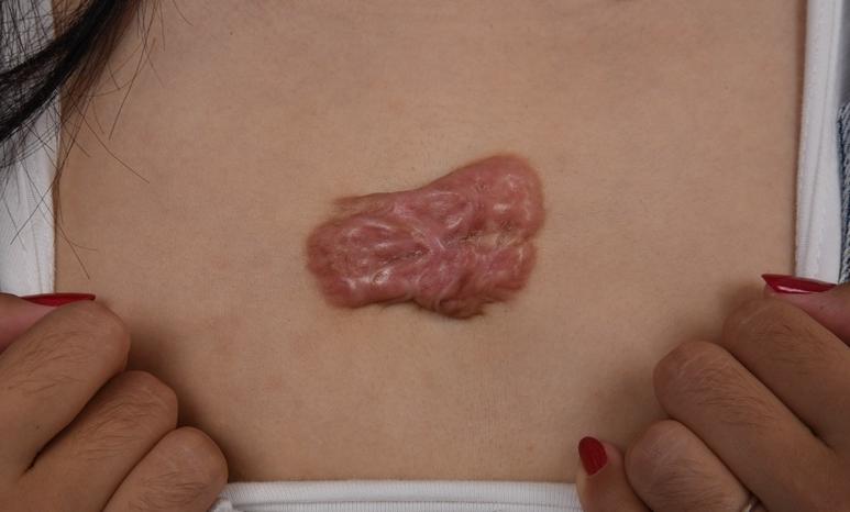 疤痕疙瘩越长越大怎么办,胸前疤痕疙瘩怎么能彻底消除