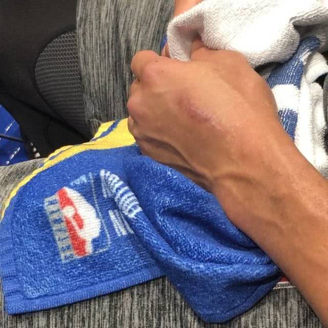 库里肩膀的伤疤,库里手腕伤疤