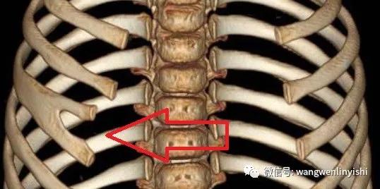 叉状肋算胸廓畸形吗,肋骨畸形与胸廓畸形的调理手法