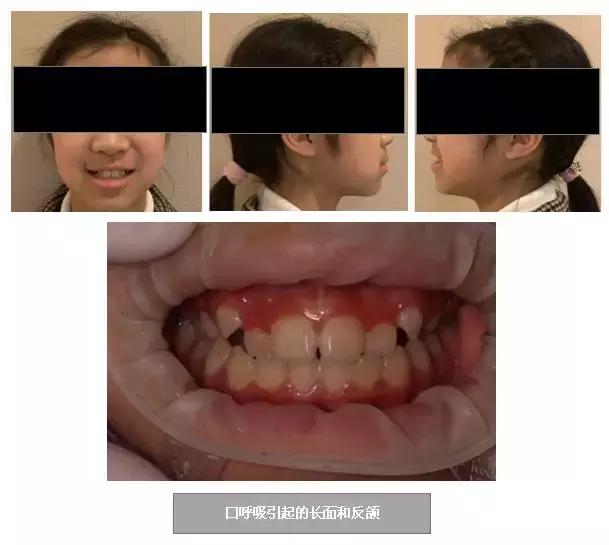 长期口呼吸的人是不是很没出息,长期口呼吸让人变丑