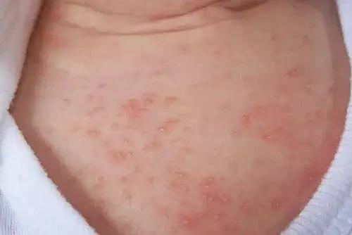 宝宝湿疹反反复复预防护理有技巧,宝宝湿疹的正确防治方法