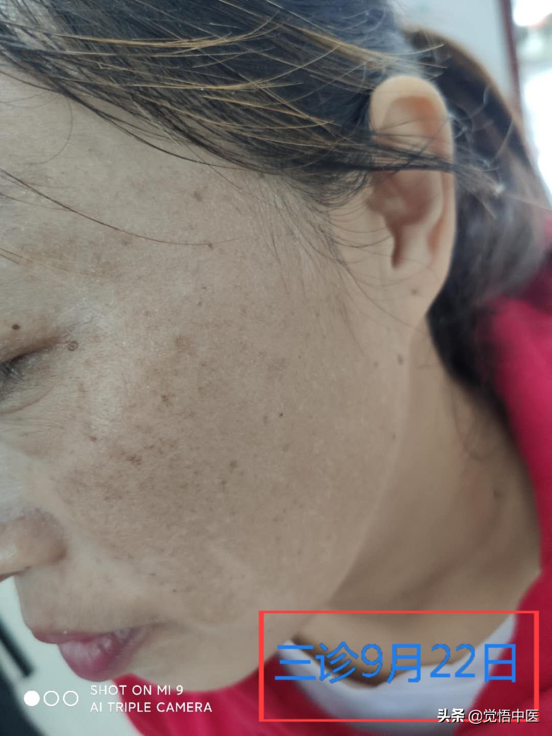 褐青色斑中医疗法,褐斑治疗药物