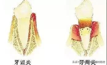 如何预防和治疗牙周炎,矫正完怎么预防牙周炎