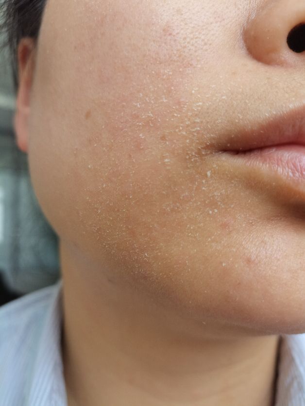 荨麻疹中医治疗方法临沂,荨麻疹护理问题及措施论文