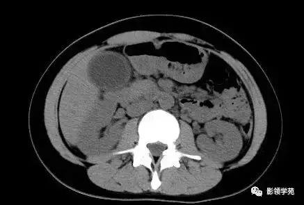 16种常见急性腹痛的诊断与鉴别