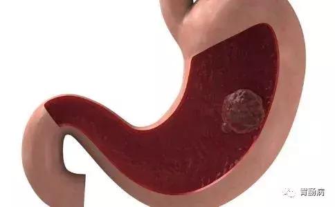 胃息肉怎样才能除根,胃息肉什么方法能除根