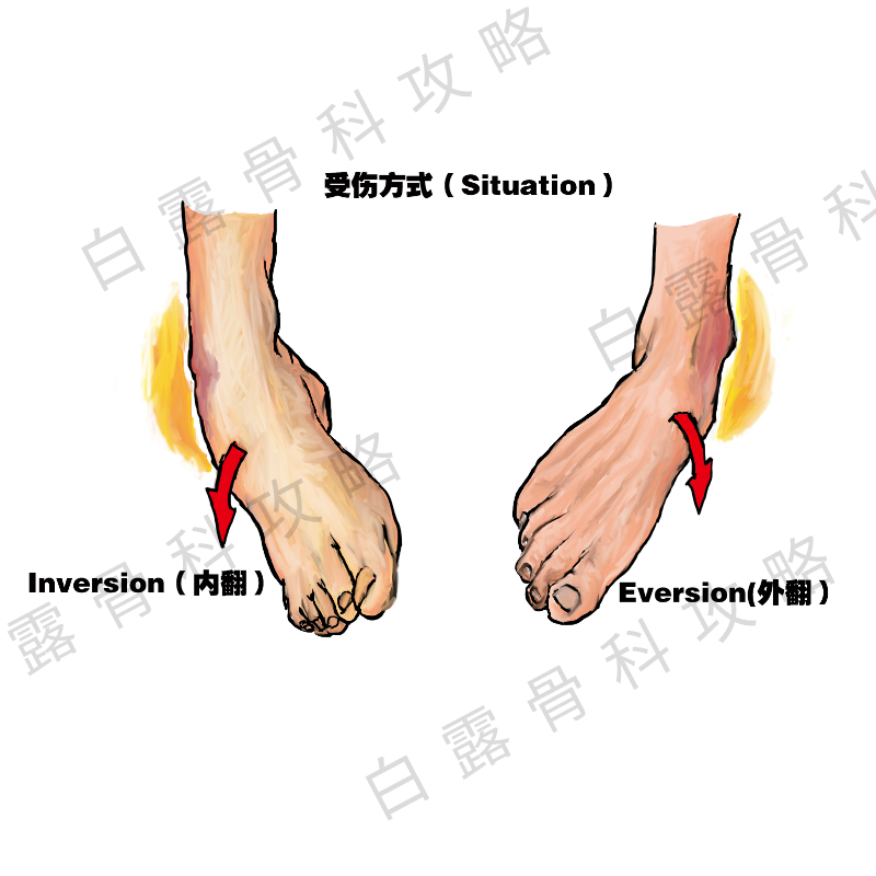 崴脚伤了脚踝怎么处理,崴到脚必须去正骨吗