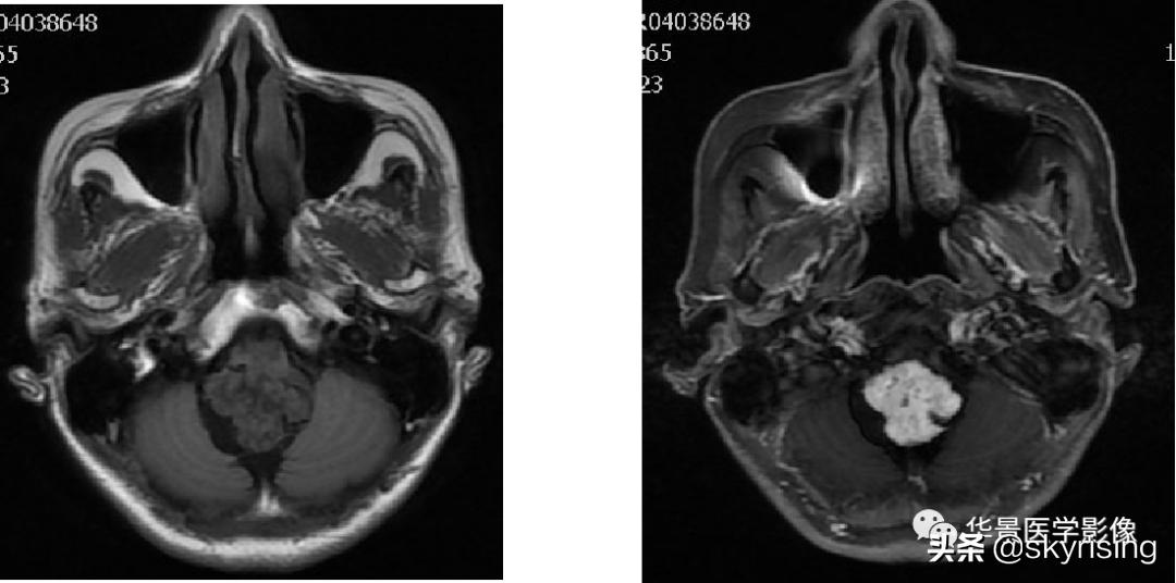 椎体侵袭性血管瘤mri影像学表现,中年妇女脑部血管海绵体瘤的症状