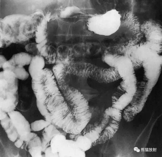 「收藏」11种消化道造影解剖图谱