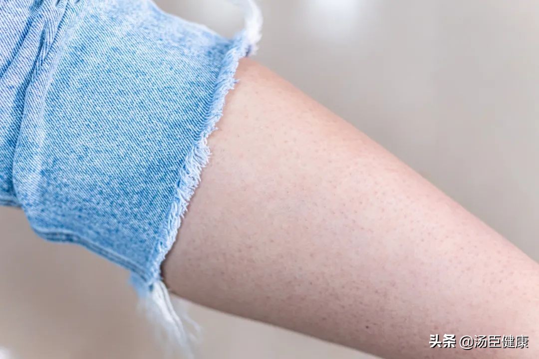 得了系统性红斑狼疮男朋友说分手,男生长了鸡皮肤