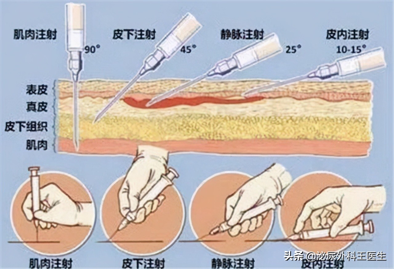 木丹颗粒治疗糖尿病周围神经病变,血府逐瘀丸治糖尿病周围神经病变
