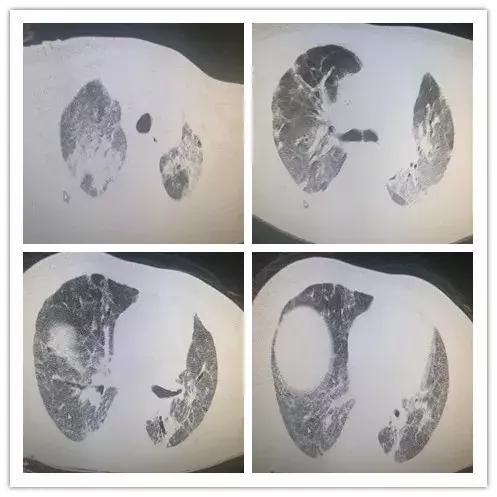 罕见病误诊的真实案例,误诊漏诊导致病人肿瘤癌变