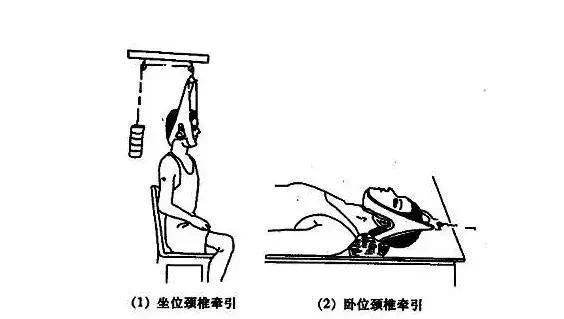 颈椎病曲度变直怎么治疗,低头族颈椎矫正的方法视频