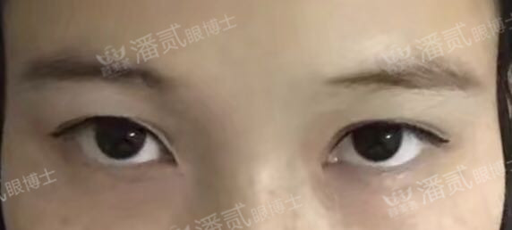 开眼角手术如何避免回缩,开眼角手术常见问题及解决方法