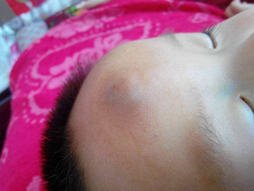 小磕小碰、摔伤烧伤在所难免，不想去医院，在家如何安全处理？