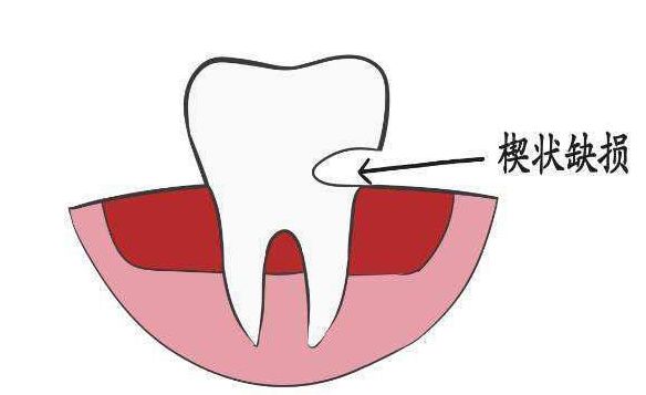 嵌体补牙的缺点,嵌体的优点和缺点简单概括