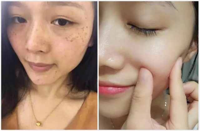 斑怎么保养才能淡,斑的处理方法
