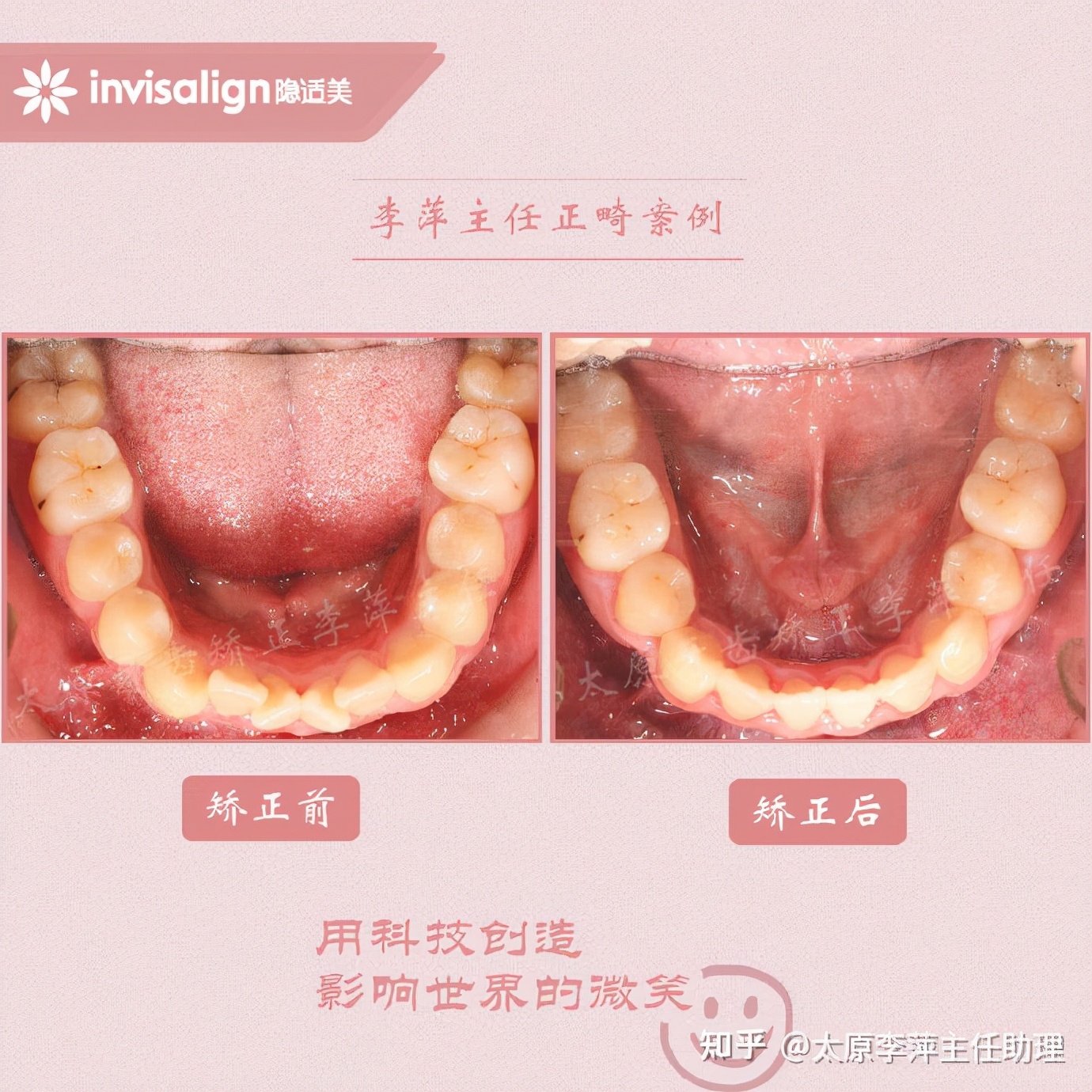 太原矫正牙齿需要做正颌吗,太原牙齿二次矫正