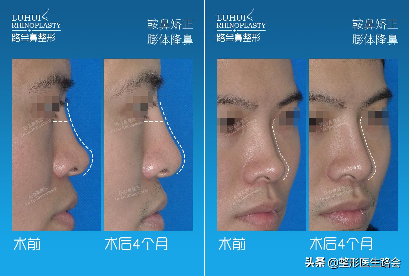 鼻翼缩小后期鼻头变宽,鼻翼变宽鼻头变大怎么改善