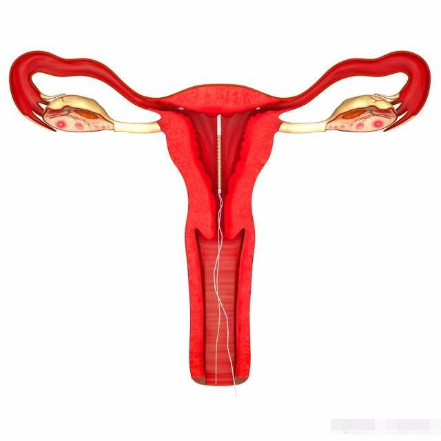 二胎取环半年内还要注意避孕吗,取环后多久可以备孕要孩子