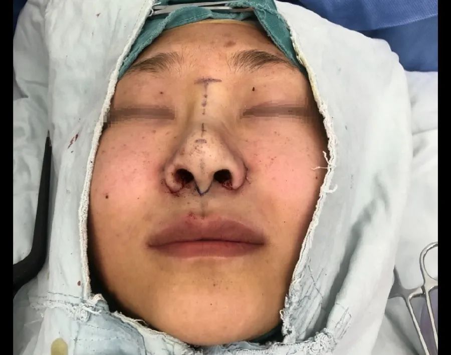 鼻头缩小鼻翼缩小前后对比图,鼻头缩小跟缩小鼻翼有区别吗