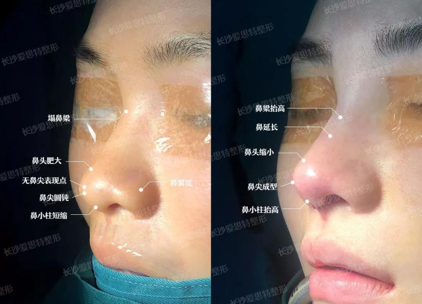 隆鼻整形手术前注意事项,隆鼻术后吃什么可以快速恢复