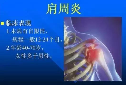 肩周炎要锻炼还是要静养,颈椎肩周炎操每天10分钟正确做法