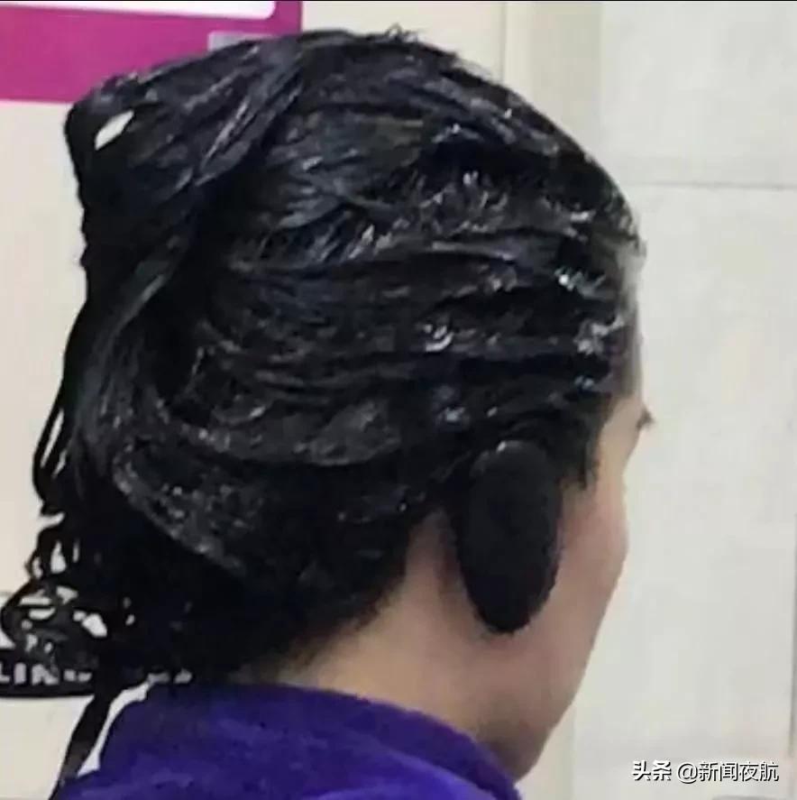 一只眼睛肿成一条缝了,眼睛肿成一条缝是什么情况